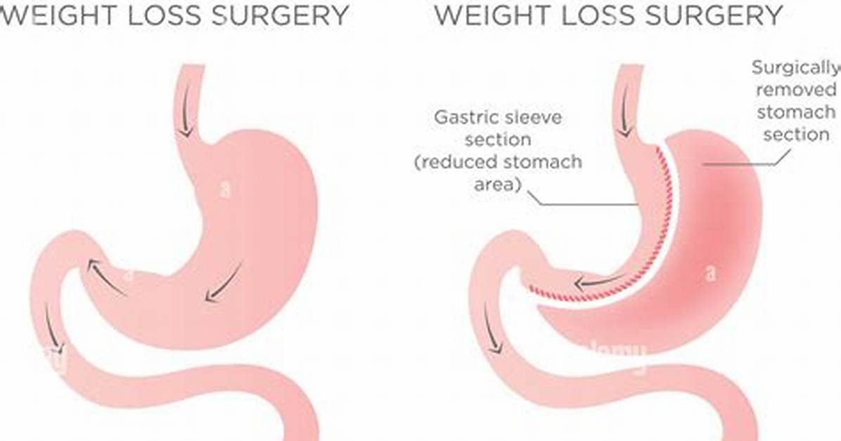 Do I Qualify for Stomach Stapling?