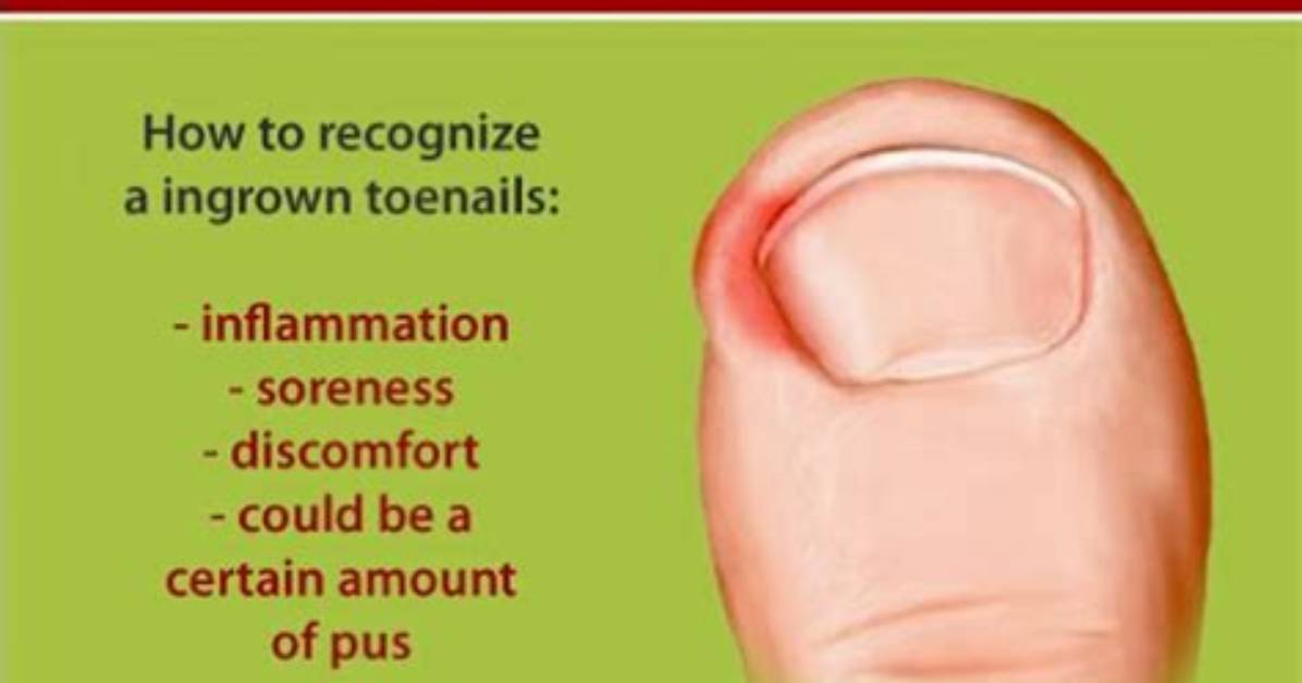 Do Ingrown Toenails Grow out?