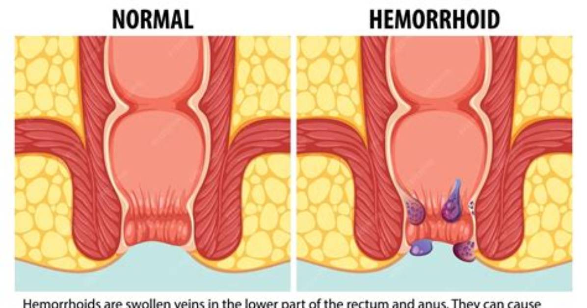 Do Internal Hemorrhoids Feel Like Pressure?