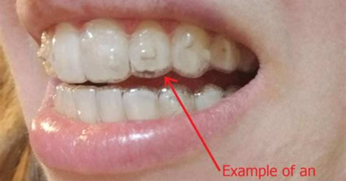 Do Invisalign Trays Get Tighter?