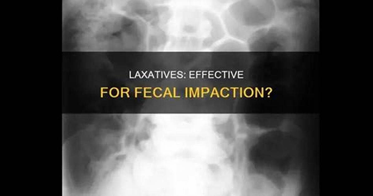 Do Laxatives Help Impaction?