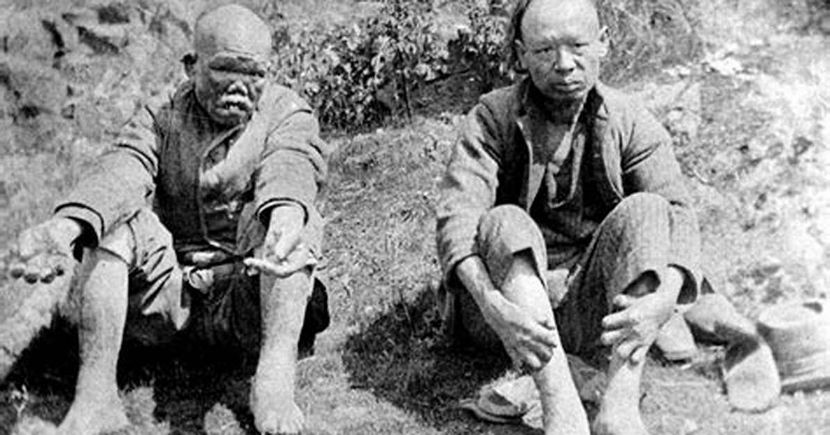 Do Leper Colonies Still Exist?