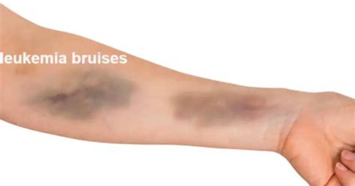 Do Leukemia Bruises Go Away?