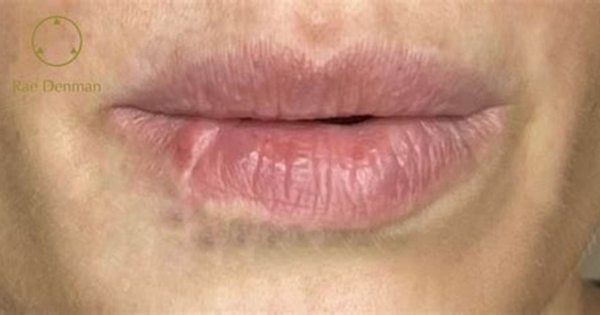 Do Lip Scars Go Away?