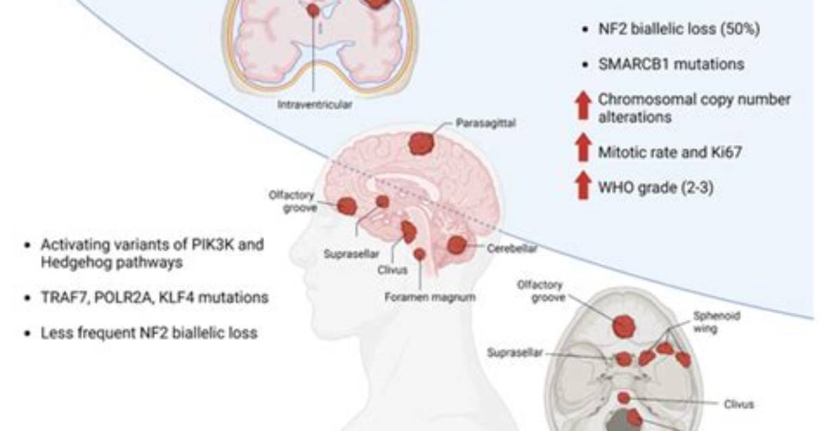 Do Meningiomas Cause Headaches?