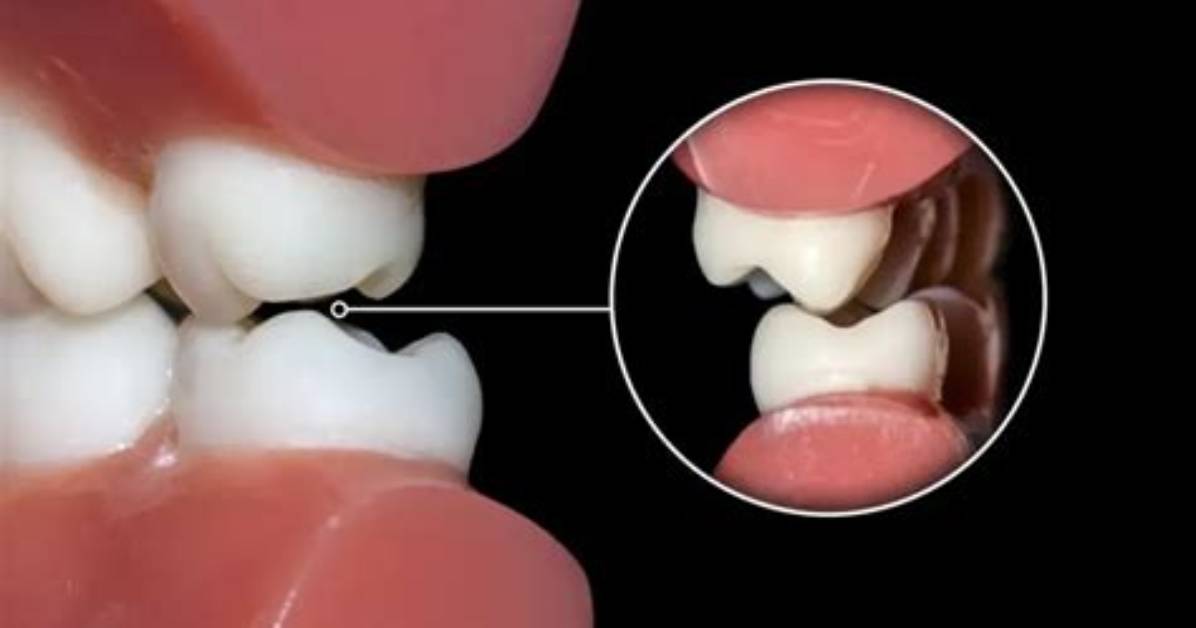 Do Molars Fall out and Grow Back?