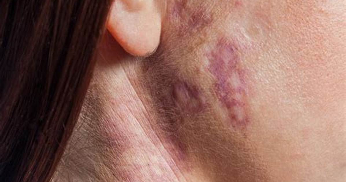 Do Mongolian Birthmarks Go Away?