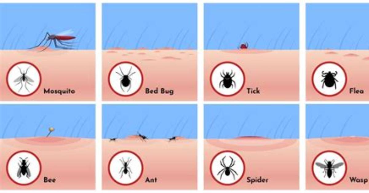 Do Mosquito Bites Get Hard?