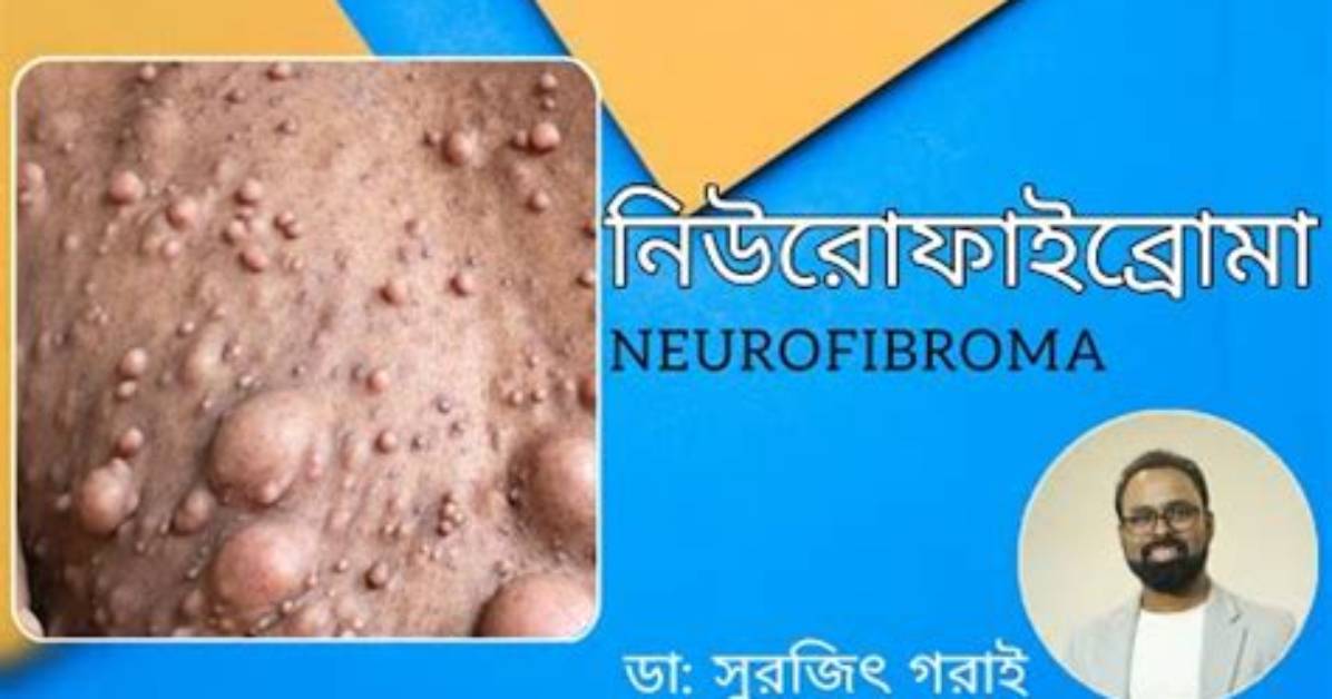 Do Neurofibromas Look Like Pimples?