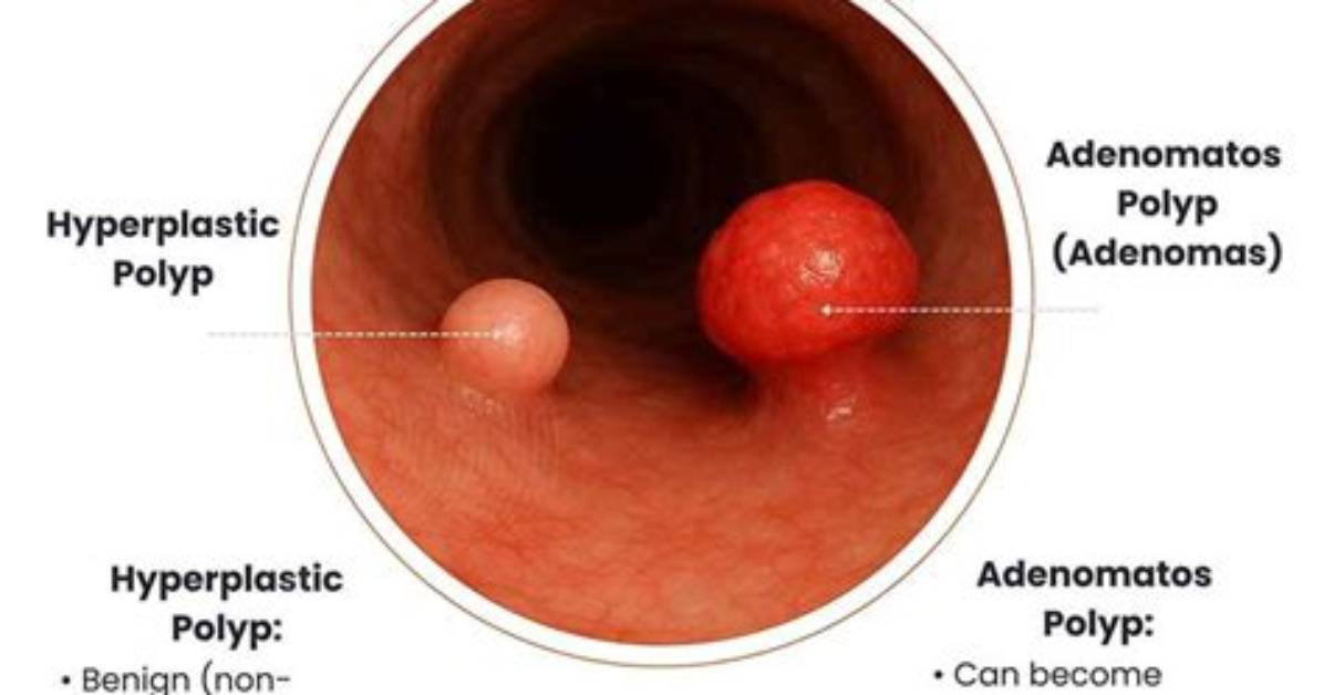 Do Non Neoplastic Polyps Bleed?