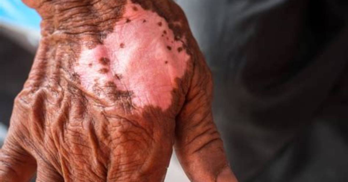 Do Only Humans Get Leprosy?