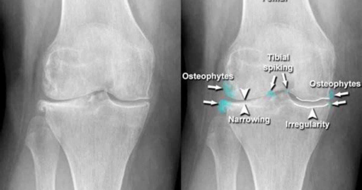 Do Osteophytes Mean Arthritis?