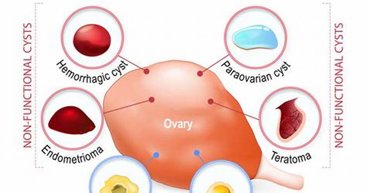 Do Ovarian Cysts Cause Bleeding?