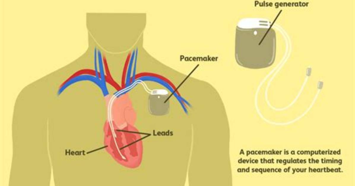 Do Pacemakers Move Around?
