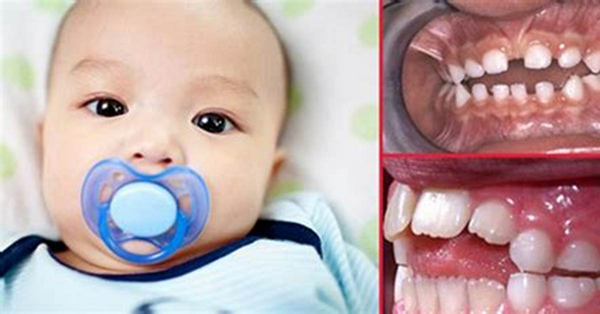 Do Pacifiers Cause Orthodontic Problems?