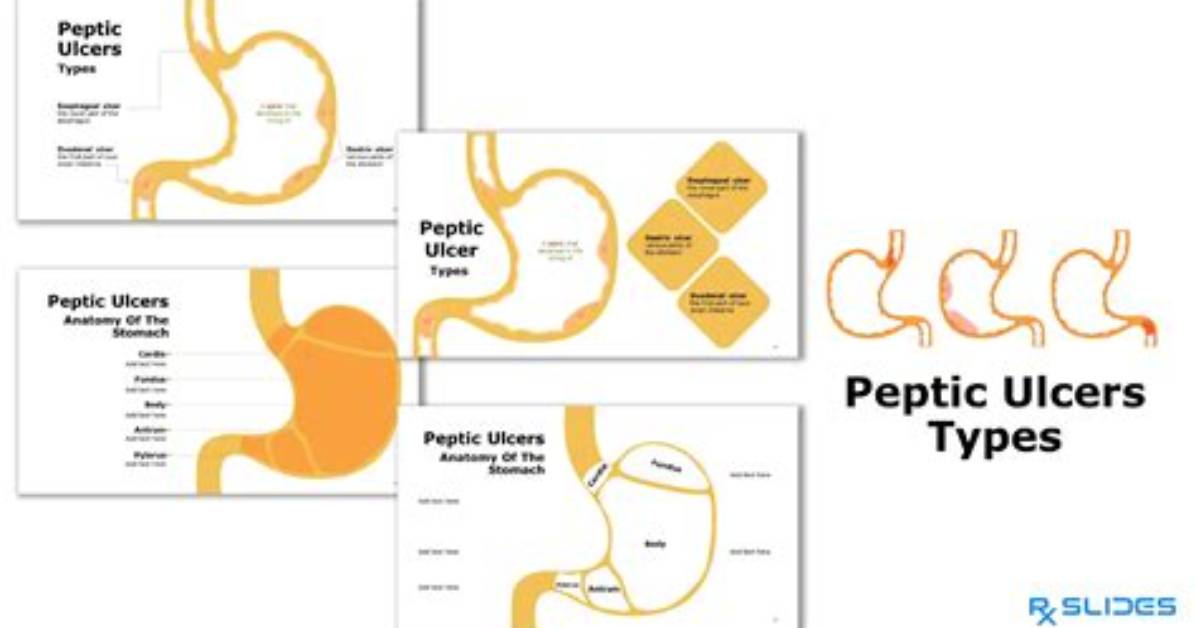 Do Peptic Ulcers Need Surgery