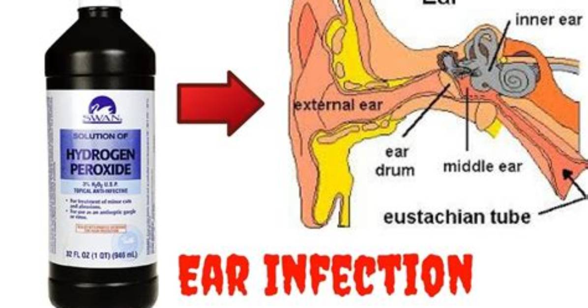 Do Peroxide Help Ear Infection?