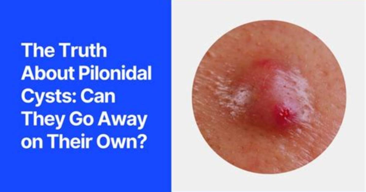 Do Pilonidal Cysts Come Back?