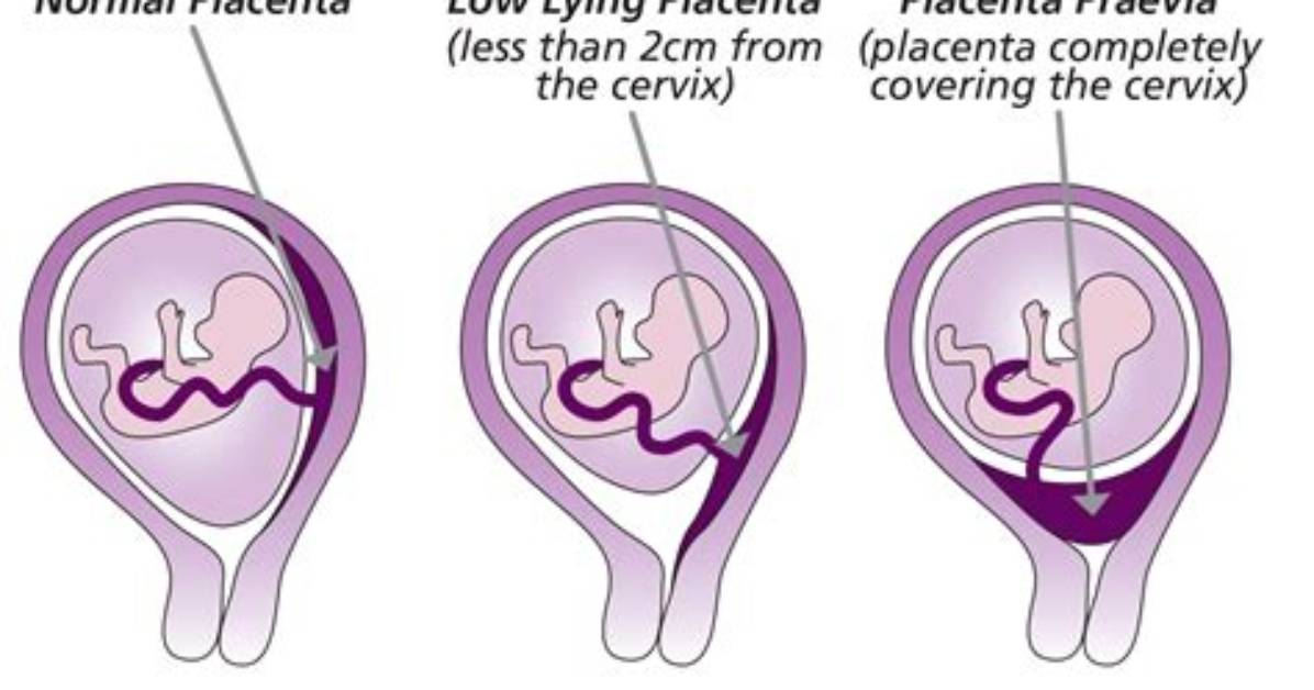 Do Placenta Move During Pregnancy?