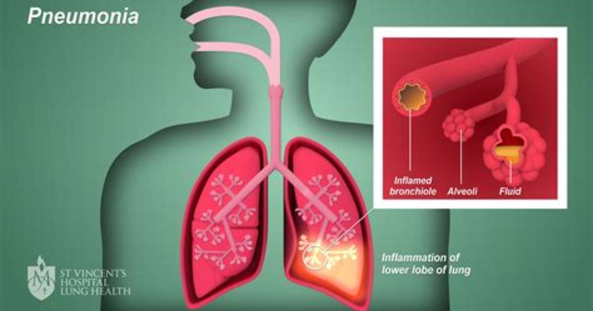 Do Pneumonia Patients Need Oxygen?
