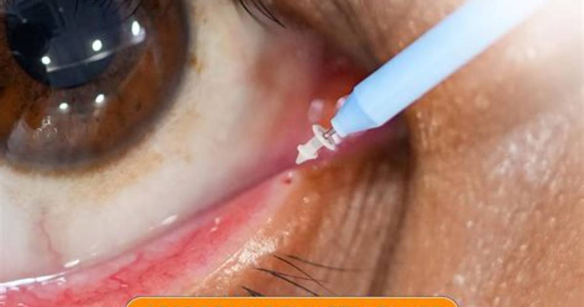 Do Punctal Plugs Work Immediately?