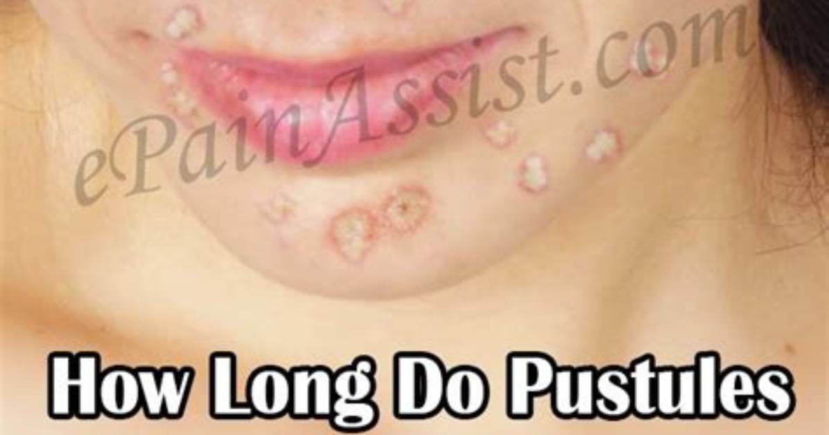 Do Pustules Go Away?