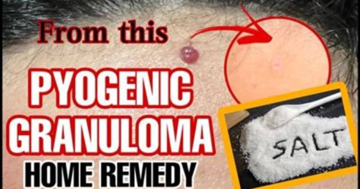 Do Pyogenic Granulomas Hurt?