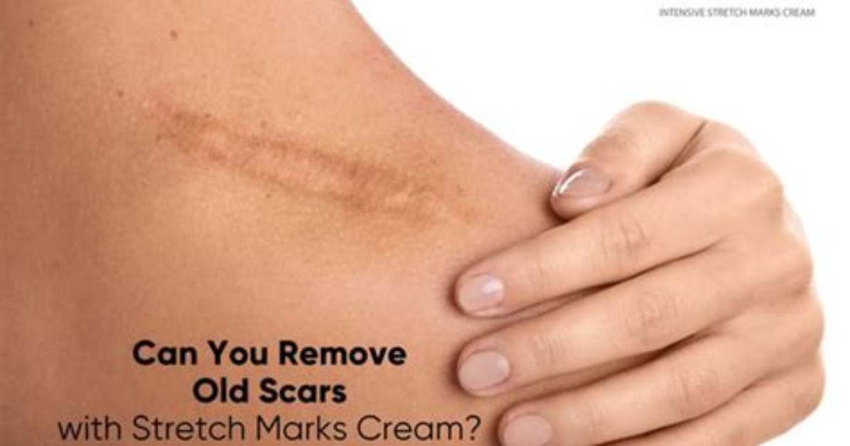 Do Scar Sheets Work on Stretch Marks?