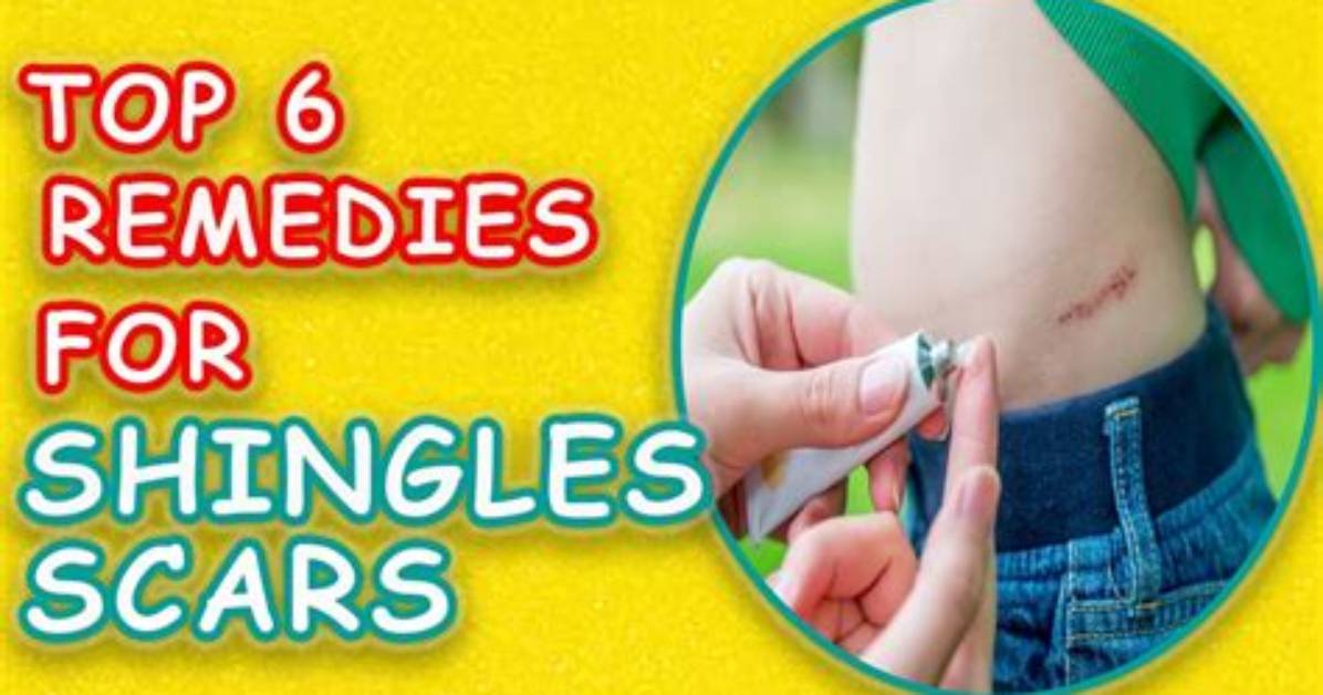 Do Shingle Scars Go Away?