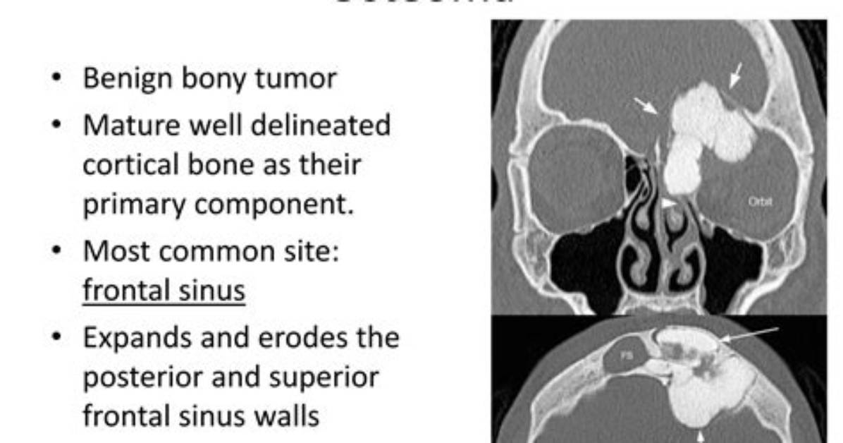 Do Skull Osteomas Stop Growing?