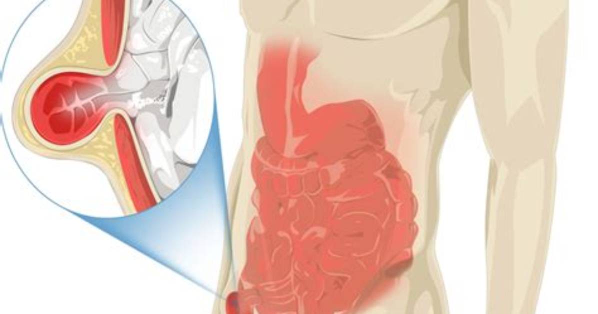 Do Spigelian Hernias Need Surgery?