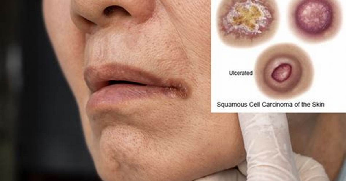 Do Squamous Cells Hurt?