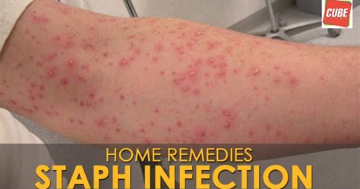 Do Staph Infections Itch?