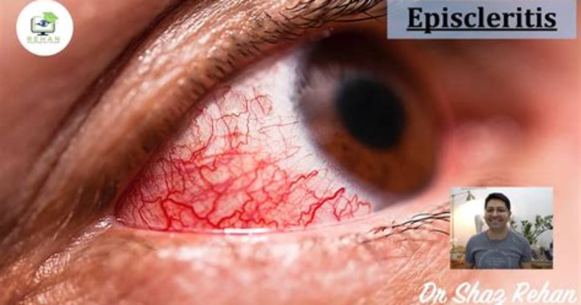 Do Stress Cause Episcleritis?