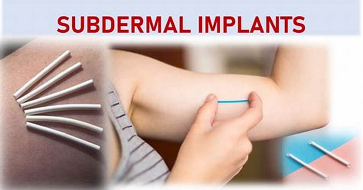 Do Subdermal Implants Hurt?