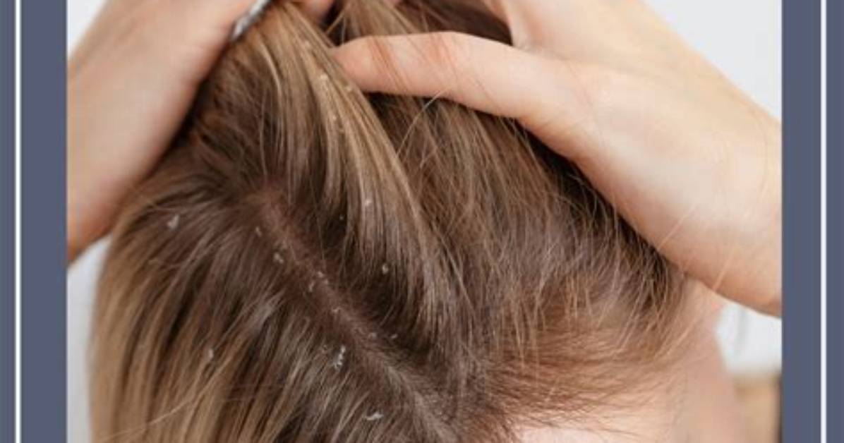 Do Sulfate Free Shampoos Cause Dandruff?