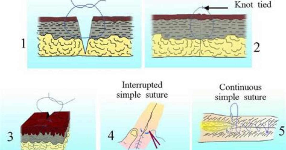 Do Sutures Fall out?