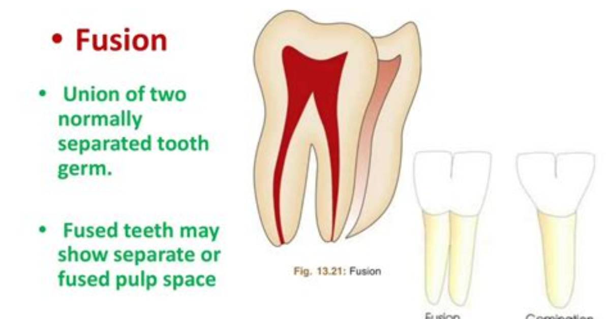 Do Teeth Fused Together?