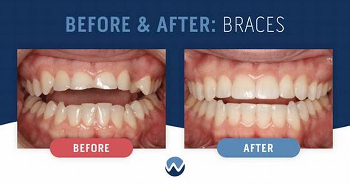 Do Teeth Go Back After Braces?