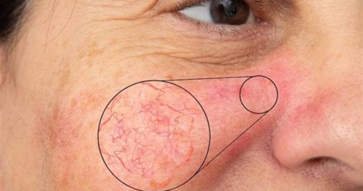 Do Telangiectasia Go Away?