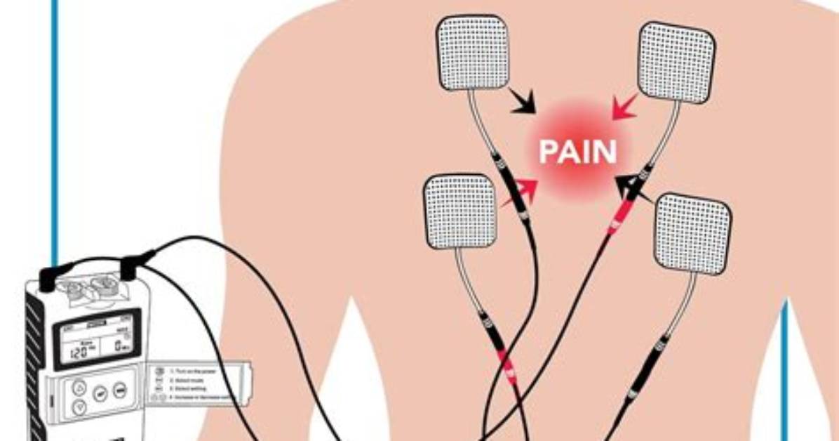 Do Tens Units Work?