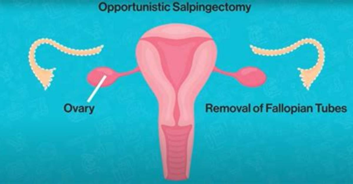 Do They Remove Your Fallopian Tubes with a Hysterectomy?