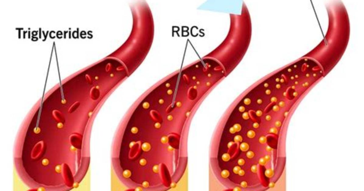 Do Triglycerides Clog Arteries?