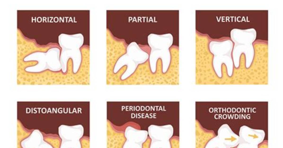 Do Unerupted Wisdom Teeth Need to Be Removed?