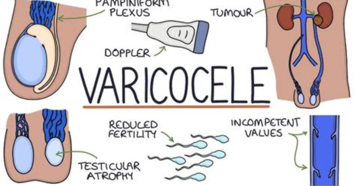 Do Varicoceles Transilluminate? | Contextresponse. Com