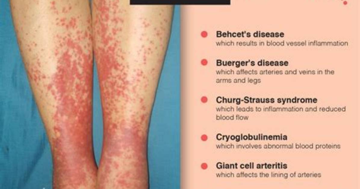 Do Vasculitis Rashes Itch?