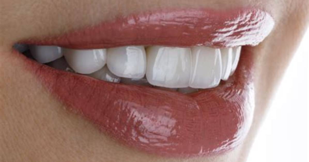 Do Veneers Come off?