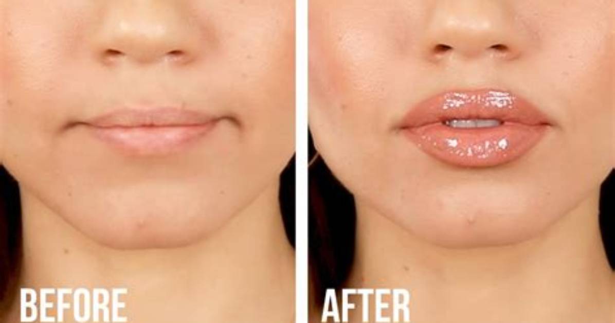 Do Veneers Make Your Lips Look Bigger?