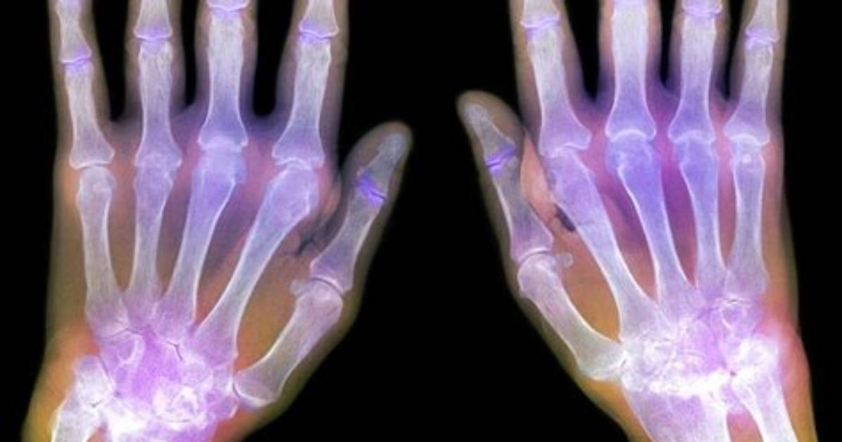 Do X Rays Show Arthritis?