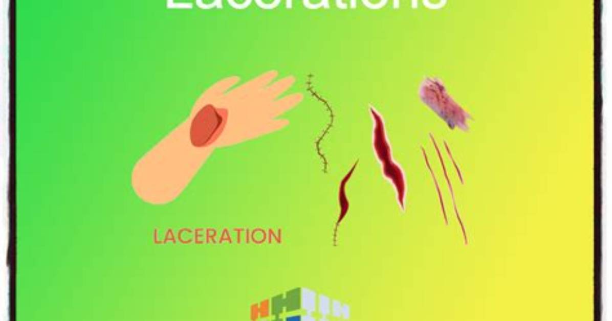 Do You Code Laceration with Open Fracture?